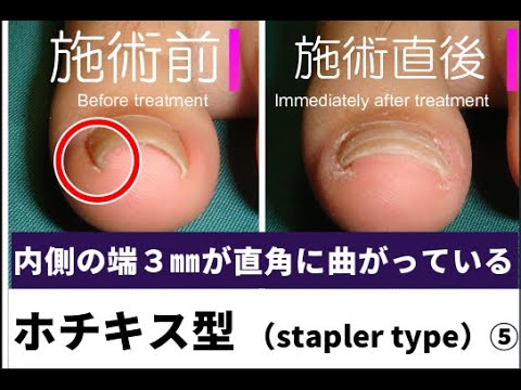 巻き爪矯正の実例032 ホチキス型 熊本市で巻き爪の悩み 矯正なら 熊本の巻き爪 ナラココ へ Youtube