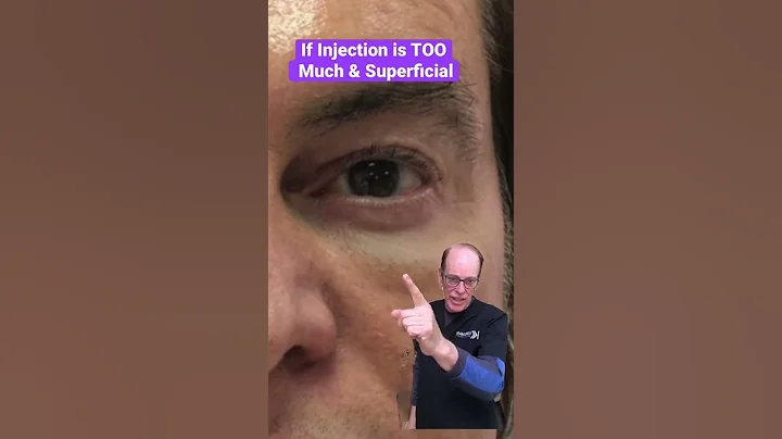 Discoloration from Eyelid Injections - AKA Tyndall...
