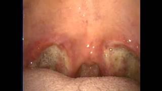 扁桃腺摘除手術後第9天post Tonsillectomy Day 9 Youtube