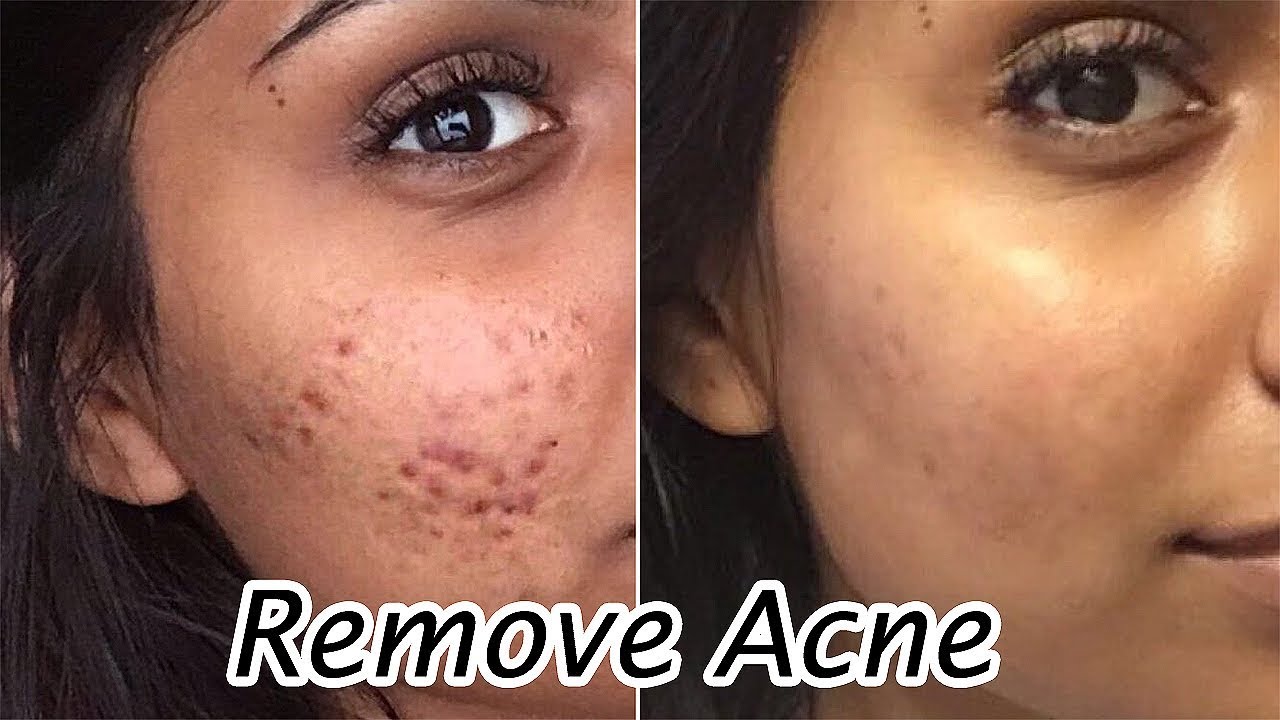 Remove Acne Marks 3 Home Remedies Better Works With Results Acne