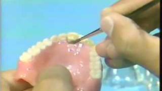 Replacing a Broken Complete Denture Tooth