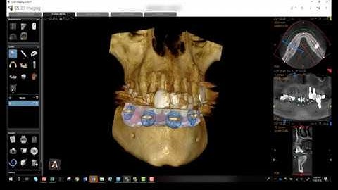CS 81003D and CS 3600 Merged Denture