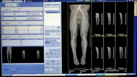 CT SCAN LOWER LIMB ANGIOGRAPHY FILMING PROCESS@RadiologyClasses @radiologytechnical1221@ctscanandmri