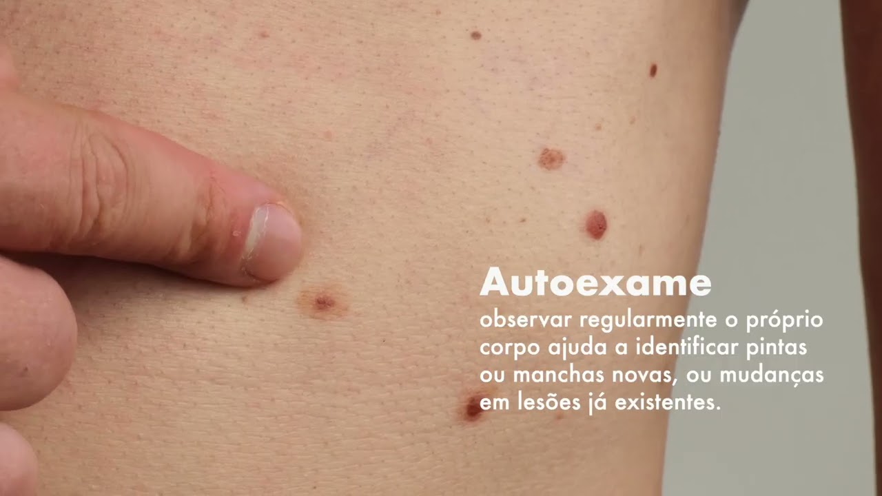Campanha Dezembro Laranja - Saúde da Pele Com Dr. Tovo | Clinica Tovo Dermatologia