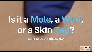Is It a Mole, a Wart, or a Skin Tag?