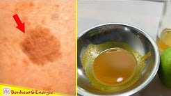 3 Minutes Pour Enlever Les Taches Brunes Sur Le Visage et La Peau Avec Recette 100% Naturelles