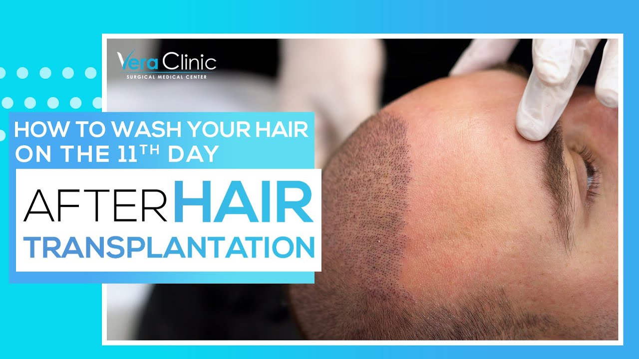 How to wash your hair on the 11th day after hair transplant operation? YouTube