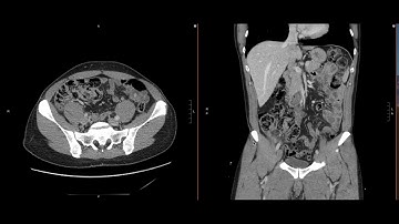 Abdominal Imaging Call Prep Cases: Acute Uncomplicated Appendicitis (CT) Case 2 Discussion