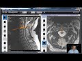 How To Read Your Cervical MRI (Part 2 of 2): Let's Go Over My Cervical MRI Disk With Onis 2.5.