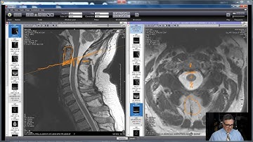 How To Read Your Cervical MRI (Part 2 of 2): Let