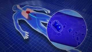 Hbot For Urologists - Healing Radiation Injury With Hyperbaric Oxygen Therapy