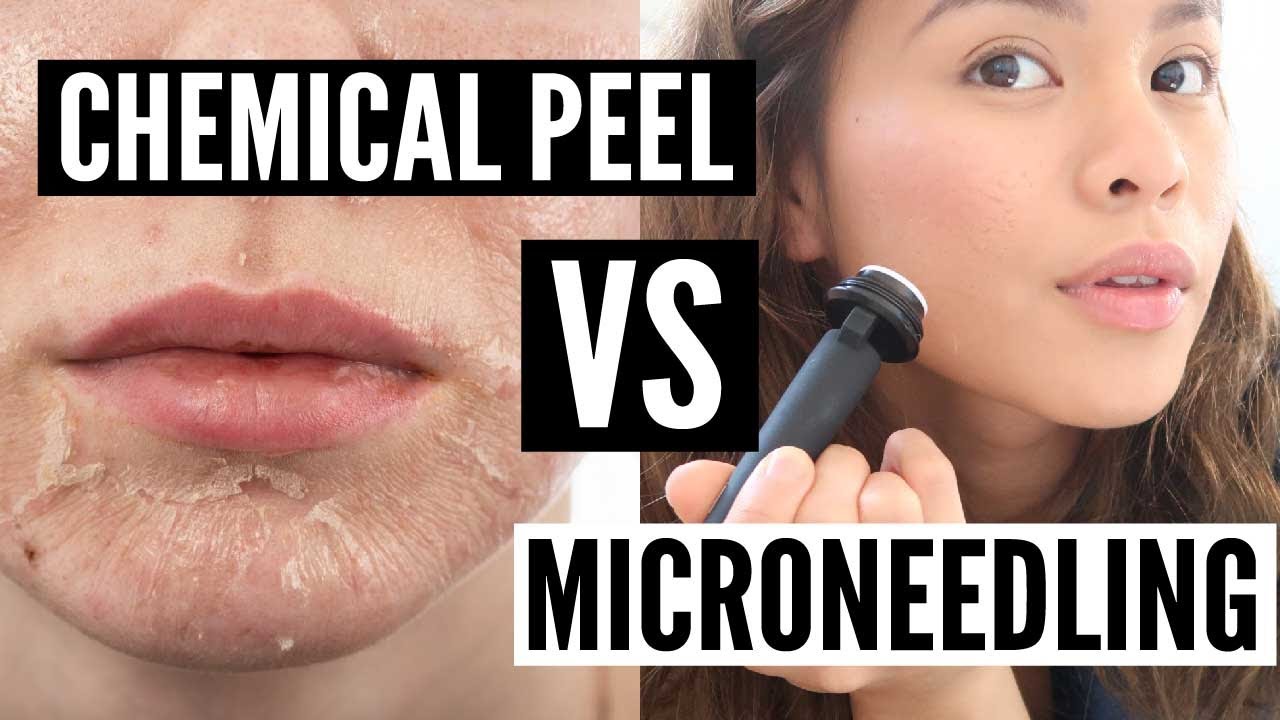 Chemical Peel Vs Microneedling