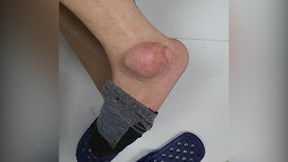Mọc khối u như quả ổi ở chân vì chữa gout bằng “thuốc nam”| VTC14