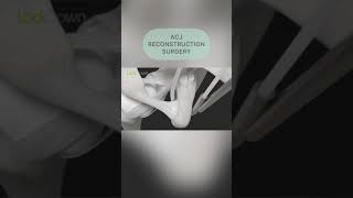 ACJ reconstruction surgery