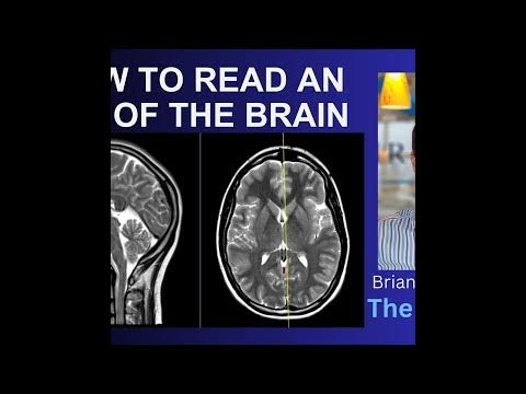 How to Read an MRI of the Brain | First Look MRI - YouTube