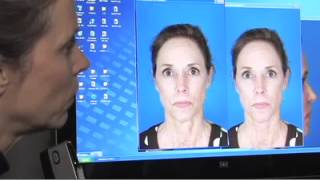 How Can I Get Rid Of Brown Spots On My Neck With A Face Lift - By Dr. Kridel