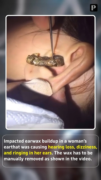 Case of Massive ear wax removal