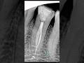 Mandibular premolar with three canals #shortvideo #rootcanal #rct #dentist