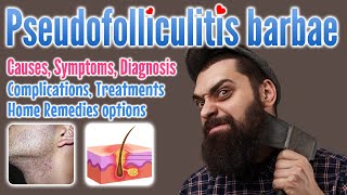 Pseudofolliculitis Barbae Overview, Causes, Symptoms, Diagnosis, Treatment, And Home Remedies