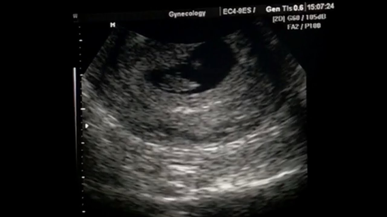 Saco Gestacional Vazio Com 7 Semanas E Normal