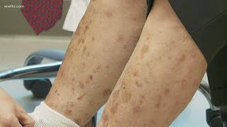 New psoriasis treatment uses light therapy, how to get in on the study