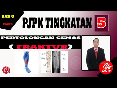 CIKGU CJ | PJPK T5 Bab 6 Pertolongan Cemas FRAKTUR, JENIS FRAKTUR, KLASIFIKASI FRAKTUR, KEPATAHAN