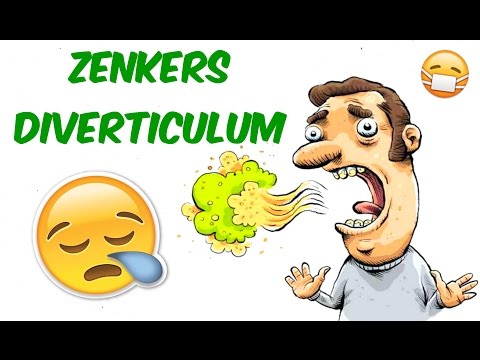 Video: Zenker's Diverticulum: Simptomi, ķirurģija, Cēloņi