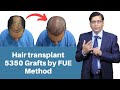 Best hair transplant india  hair transplant results 2021  hair transplant clinic  dr anil garg