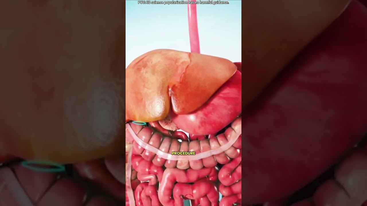 Gallbladder removal surgery 3D animation (cholecystectomy)