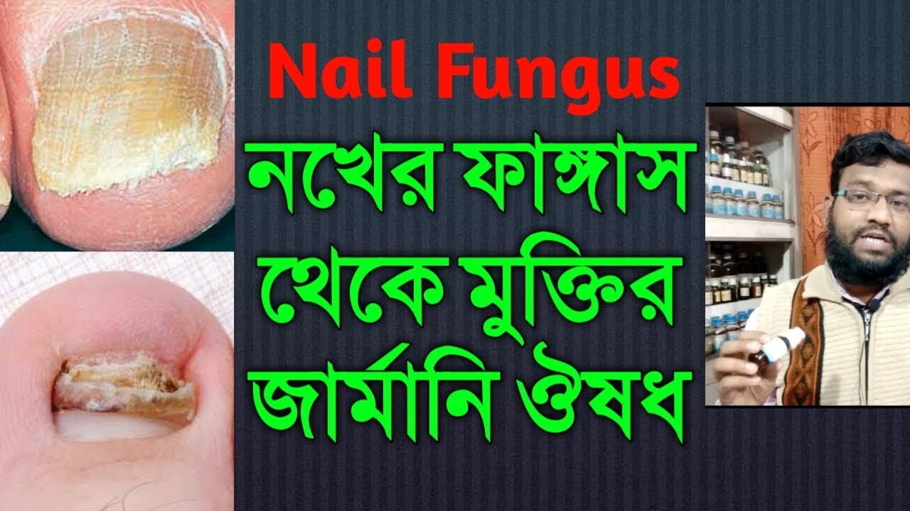 নখের ফাঙ্গাস দূর করার হোমিওপ্যাথি উপায় | nail fungus homeopathic treatment in bangla