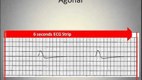 ECG Interpretation Video Lecture 5-A