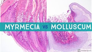 Molluscum vs Myrmecia Wart - Dermpath Lookalikes