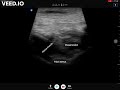 Pericapsular nerve group (PENG) block of the hip for chronic hip pain
