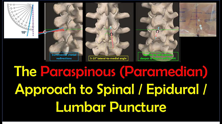 Paraspinous (Paramedian) Approach to Spinal & Epidural & LPs - Why and How to Do It