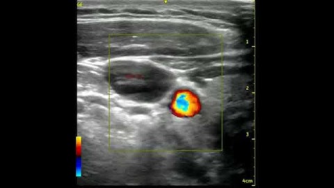 IJV Valsalva color doppler