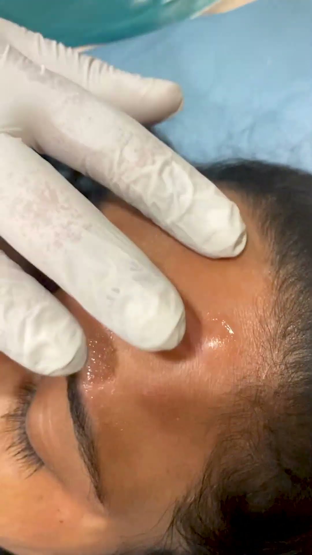 The Power of Botox — Rejuvenate Without Surgery