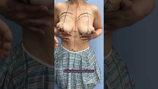 Part 1 Dermal Bra Suspension Breast Lift, Reverse Tummy Tuck, Internal J-Thoracoplasty