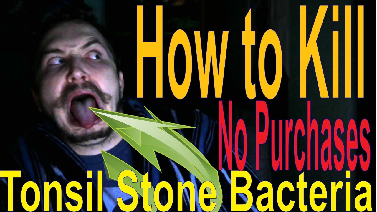 How To Treat Tonsil Stones Before Needing Manual Removal Real Talk