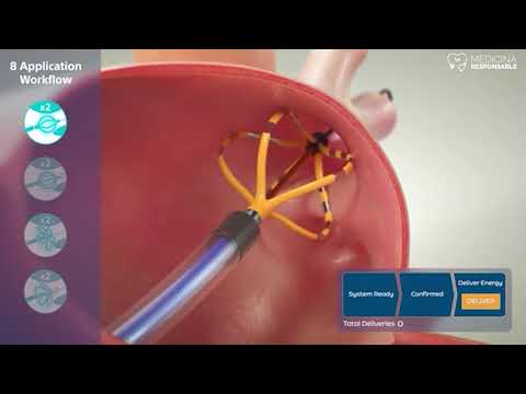 Ablación por campo eléctrico pulsado:el nuevo modelo para el tratamiento de la fibrilación auricular