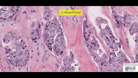 Grading of Breast Carcinoma
