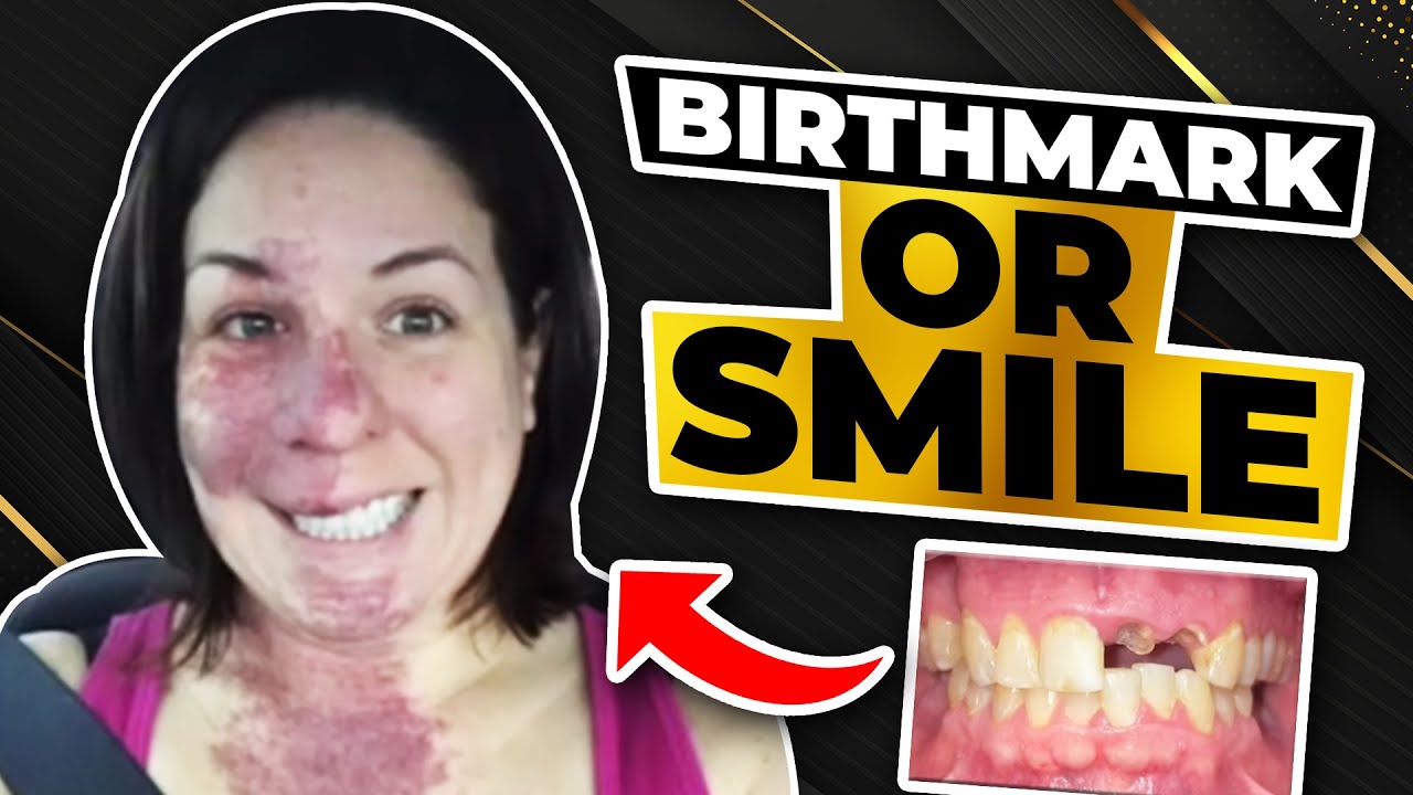 Birthmark or Smile? - YouTube