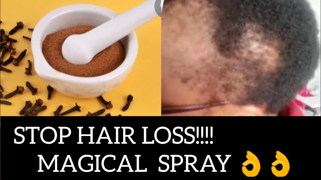 CLOVES POWDER HAIR SPRAY/TREAT BALDNESS/STOP HAIR LOSS/HOW TO/GROW LONG