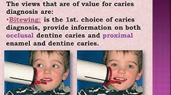 Dental caries definition , classification and etiology 