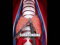 What Happens During Thyroid Surgery? #thyroidectomy #medical #health