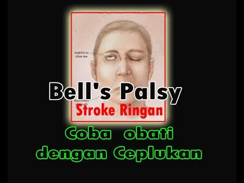 Video Pantangan Makanan Untuk Penderita Bell'S Palsy