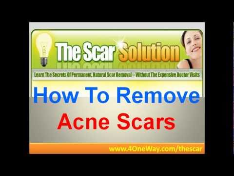 How To Remove Acne Scars | Scar Removal Treatment