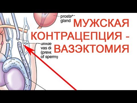 Мужская контрацепция – Вазэктомия / Доктор Черепанов