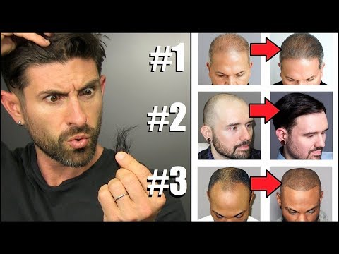 Top 3 Hair Loss Fixes EVERY GUY SHOULD KNOW ABOUT!