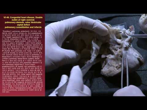 VI. DORV-46. Double outlet of Rt. ventricle pulmonary stenosis