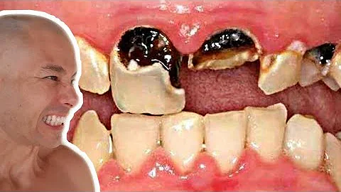 O que fazer quando o dente tá podre?